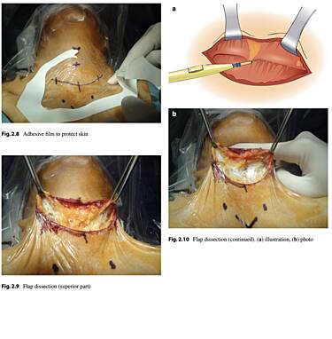 Chirurgia tarczycy - operacje metodą klasyczną, endoskopowe i z użyciem robota