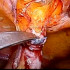 Uroginekologia laparosokopowa