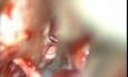 Mikrochirurgiczne usunięcie perlaka zlokalizowanego w kącie mostowo-móżdżkowym