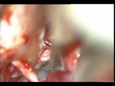 Mikrochirurgiczne usunięcie perlaka zlokalizowanego w kącie mostowo-móżdżkowym