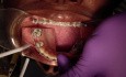 Jak Poprawnie założyć łańcuszek ortodontyczny, aby Zapobiec Przypadkowej Rotacji Zębów?