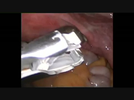 Podwiązanie jajowodów laparoskopowe przy użyciu klipsów Flishie'go