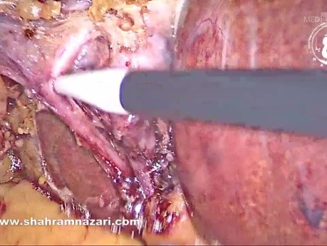 Gdy kształt pęcherzyka żółciowego utrudnia cholecystektomię: nietypowa anatomia szypuły pęcherzykowej