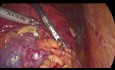 Częściowa nefrektomia metodą laparoskopową