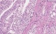 Prostata - Gruczolakorak (Gleason stopień 4) - Badanie histopatologiczne