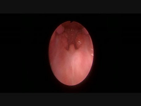 Endoskopowy obraz gardła podczas tonsilektomii z użyciem zestawu Boyle Davis Gag Set