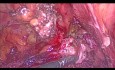 Endometrioza pęcherza moczowego i moczowodu