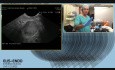 Biopsja aspiracyjna cienkoigłowa (FNB) pod kontrolą ultrasonografii endoskopowej (EUS)