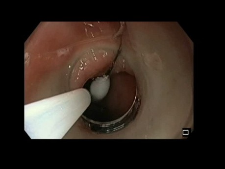 Endoskopowe usunięcie ciała obcego (szpilki) z żołądka