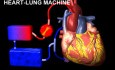 Pomostowanie aortalno-wieńcowe- animacja