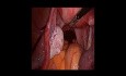 Ciąża pozamaciczna jajowodowa rozpoznana przypadkowo - laparoskopia 