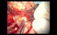 Tympanoplastyka typu second – look z ossikuloplastyką typu MFA 