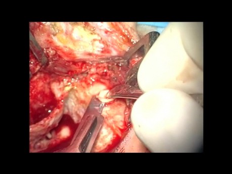 Tympanoplastyka typu second – look z ossikuloplastyką typu MFA 