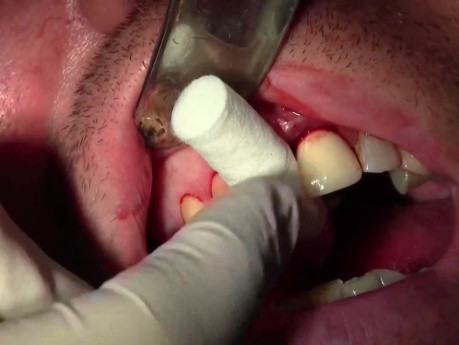 Ekstrakcja zęba #8 z  przeszczepem kostnym
