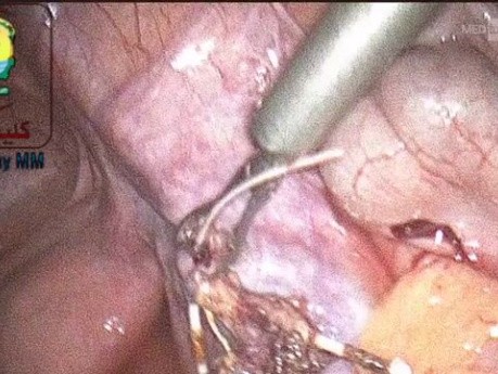 Podczas usuwania przemieszczonej wkładki wewnątrzmacicznej (IUD) można użyć trokaru jako worka do ekstrakcji