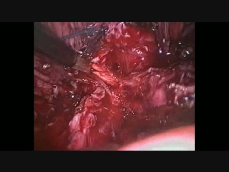 Pęczek naczyniowo-nerwowy lewy - laparoskopowa radykalna prostatektomia 