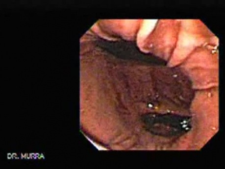 Żołądek - endoskopia - sekwencja wideo (2 z 6)
