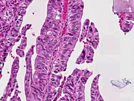 Zewnątrzwątrobowe drogi żółciowe, przewód żółciowy wspólny - histopatologia