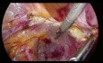 U początku tętnicy macicznej - laparoskopowo