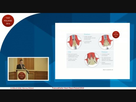 TAVI in aortic insufficiency in patient after surgical valve sparing aortic root replacement