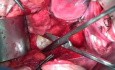 Anatomia miednicy - 3 awaskularne przestrzenie przednie