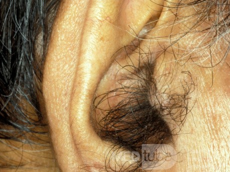 Owłosiony skrawek ucha (tragus)