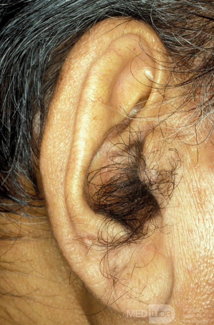 Owłosiony skrawek ucha (tragus)