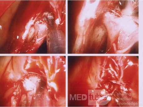 Endoskopowe podwązanie tętnicy klinowo-podniebiennej
