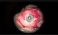 Wszczepienie sztucznych tęczówek w obu oczach