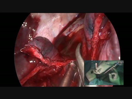 Zatamowanie krwawienia z atypowo położonej tętnicy w trakcie operacji złożonego guza techniką Uniportal VATS