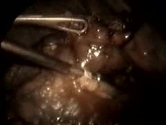 Fiberoskopia w chirurgii klatki piersiowej