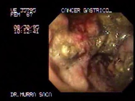 Gruczolakorak trzonu żołądka - niedrożność - endoskopia