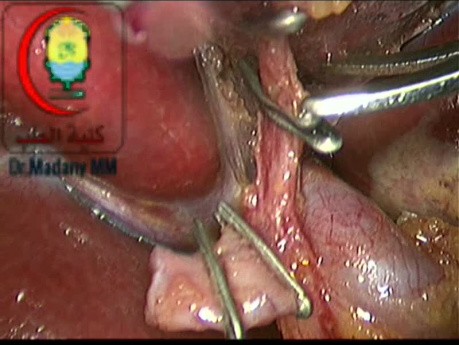 Podział tętnicy pęcherzykowej w obecności "Caterpillar hump" prawej tętnicy wątrobowej