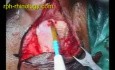 Implantacja ślimakowa- część 1