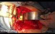 Omentoplastyka w cystach wątroby wywołanych przez bąblowca