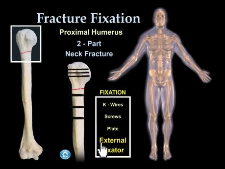 Zaopatrzenie ortopedyczne złamań - Animacja