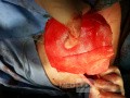 "No-pec touch" - rekonstrukcja piersi z użyciem implantu oszczędzającego mięsień piersiowy większy