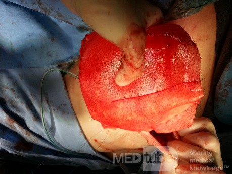 "No-pec touch" - rekonstrukcja piersi z użyciem implantu oszczędzającego mięsień piersiowy większy
