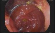Endoskopia wyrostka robaczkowego