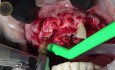Ekstrakcja zęba i natychmiastowa implantacja