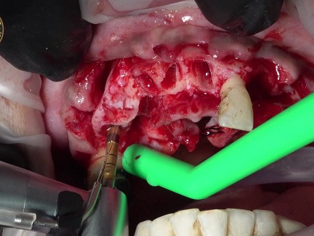 Ekstrakcja zęba i natychmiastowa implantacja