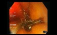 Endoskopia w świetle białym vs obrazowanie w wąskim paśmie światła (NBI) vs chromoendoskopia (z płynem Lugola)