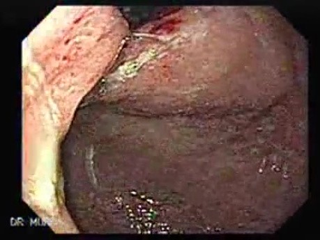 Gruczolakorak wpustu żołądka - główna zmiana w dnie żołądka widziana w inwersji endoskopowej