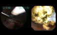 Laparoskopowa eksploracja PŻW z wydobyciem 45 wewnątrz- i zewnątrzwątrobowych kamieni żółciowych