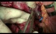 Pankreatoduodenektomia z powodu miejscowo złośliwego gruczolakoraka dwunastnicy
