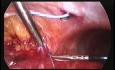 Moczowód retrokawalny (Retrocaval Ureter) - laparoskopowa transpozycja i zespolenie
