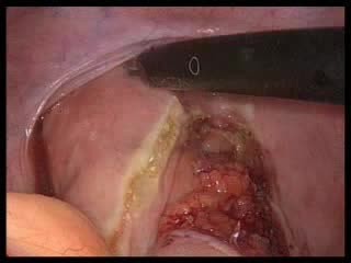 Rektopeksja laparoskopowa z powodu wypadania odbytnicy