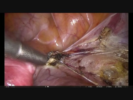 Histerektomia stan po cięciu cesarskim - otwarcie przestrzeni zewnątrzotrzewnowej za pomoc noża plazmowego