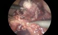 Cholecystektomia retrogradacyjna u pacjentów z marskością wątroby
