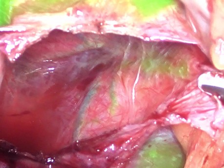 Obrazowanie fluorescencyjne z użyciem ICG podczas laparoskopowej fenestracji torbieli wątroby